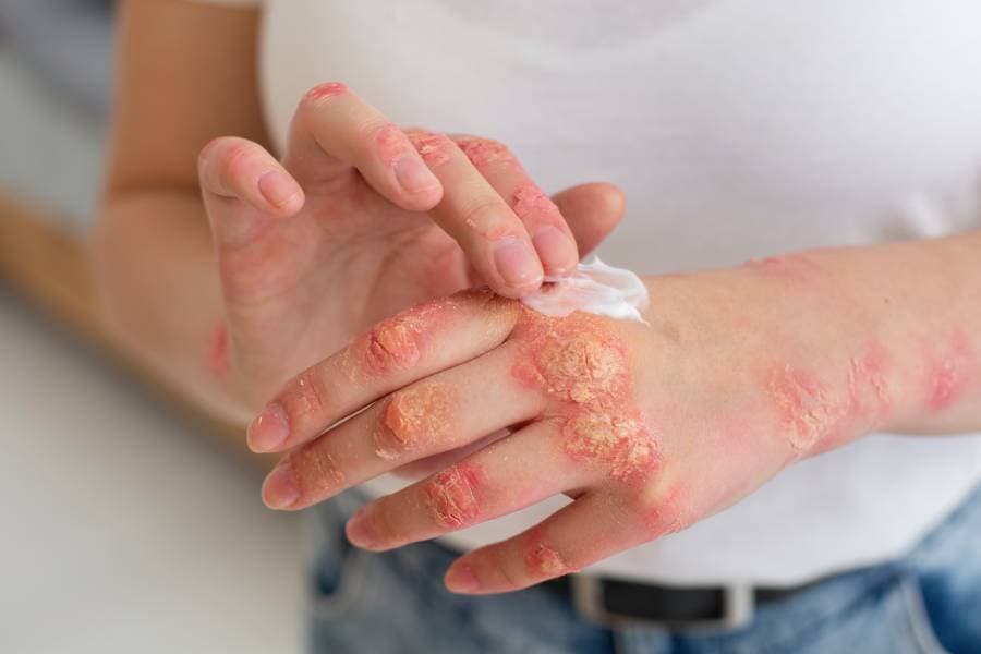 What Helps Eczema?