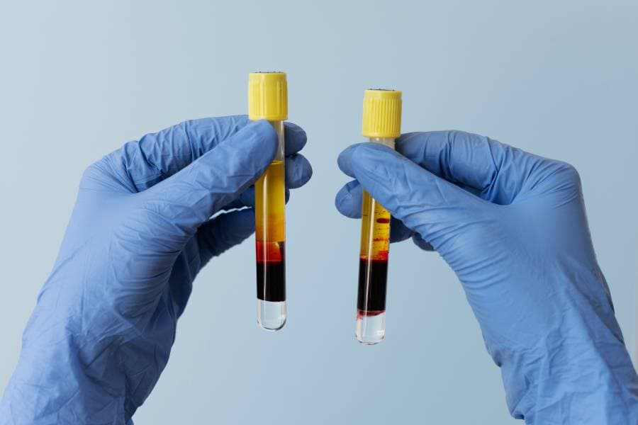 What Is PRP Treatment?
