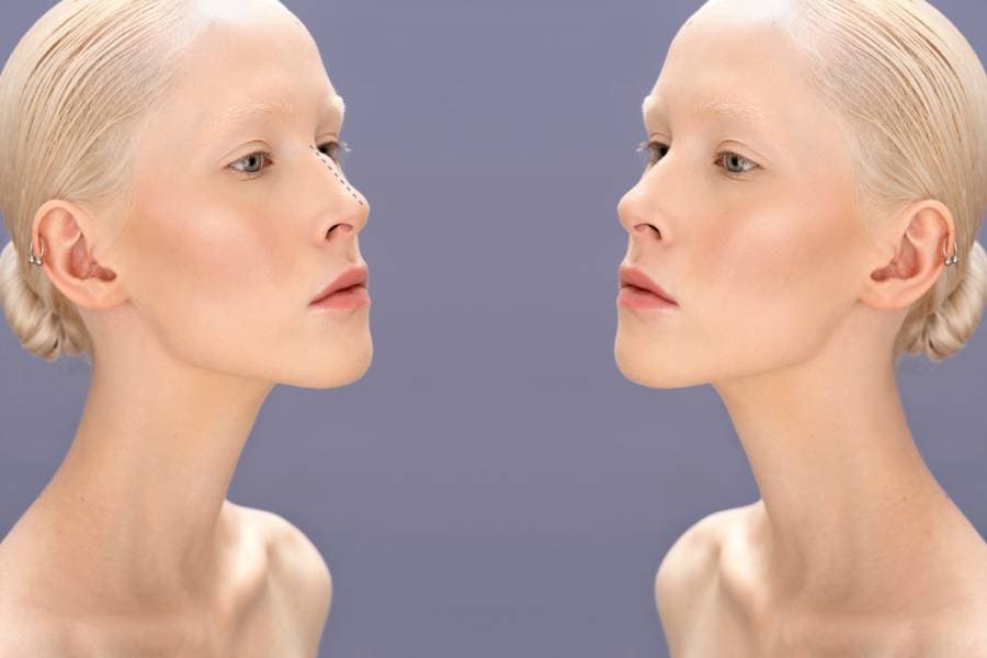 Septoplasty: How Does It Correct a Deviated Septum?