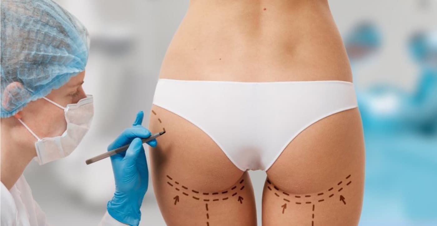 How Is Buttock Augmentation (BBL) Surgery Performed?