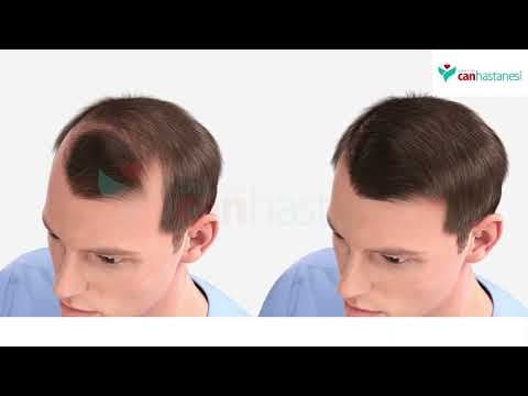 Cover image for the video The Hair Transplant Process - İzmir Özel Can Hastanesi