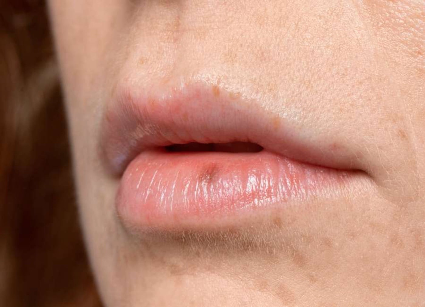 How Do Cold Sores Go Away?