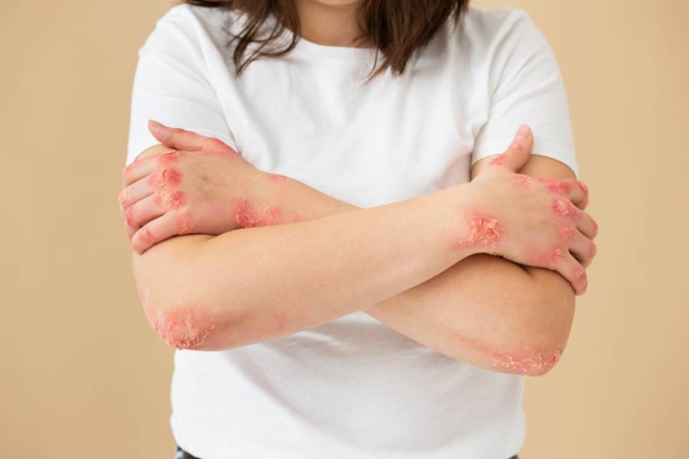 What Is Urticaria (Hives)?
