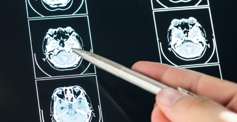 Everything About Brain Tumors, Their Symptoms and Treatment Options