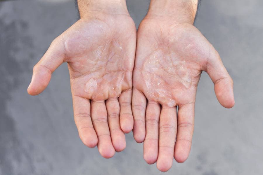 How Are Sweaty Hands Treated?