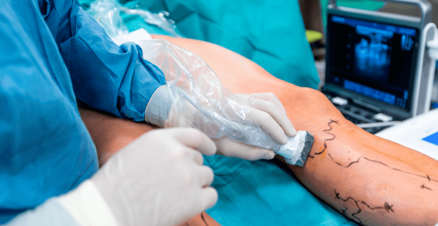 Varicose Vein Treatment