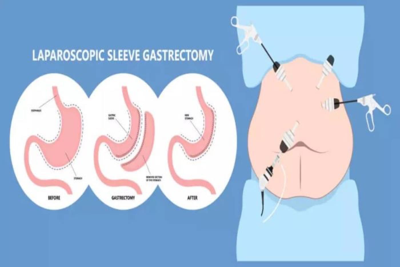 Who Is a Candidate for Sleeve Gastrectomy?