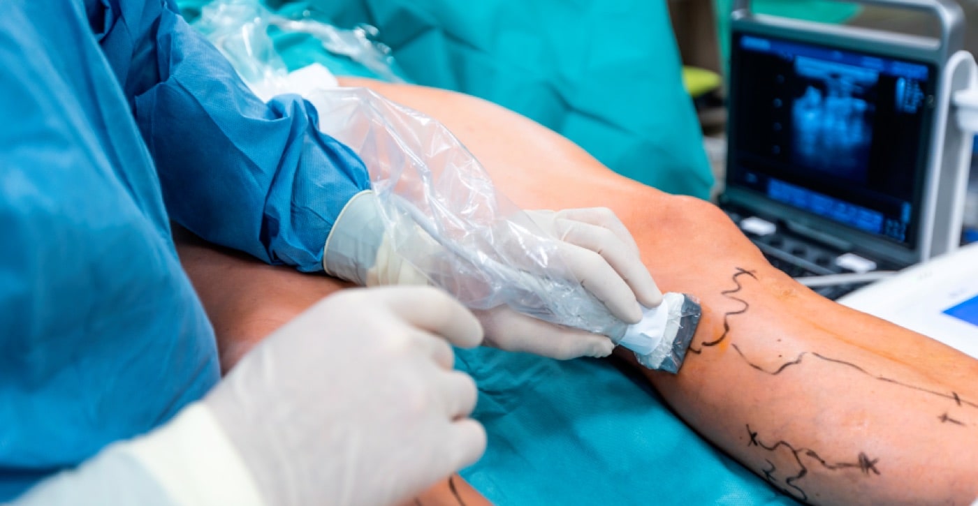 Varicose Vein Treatment