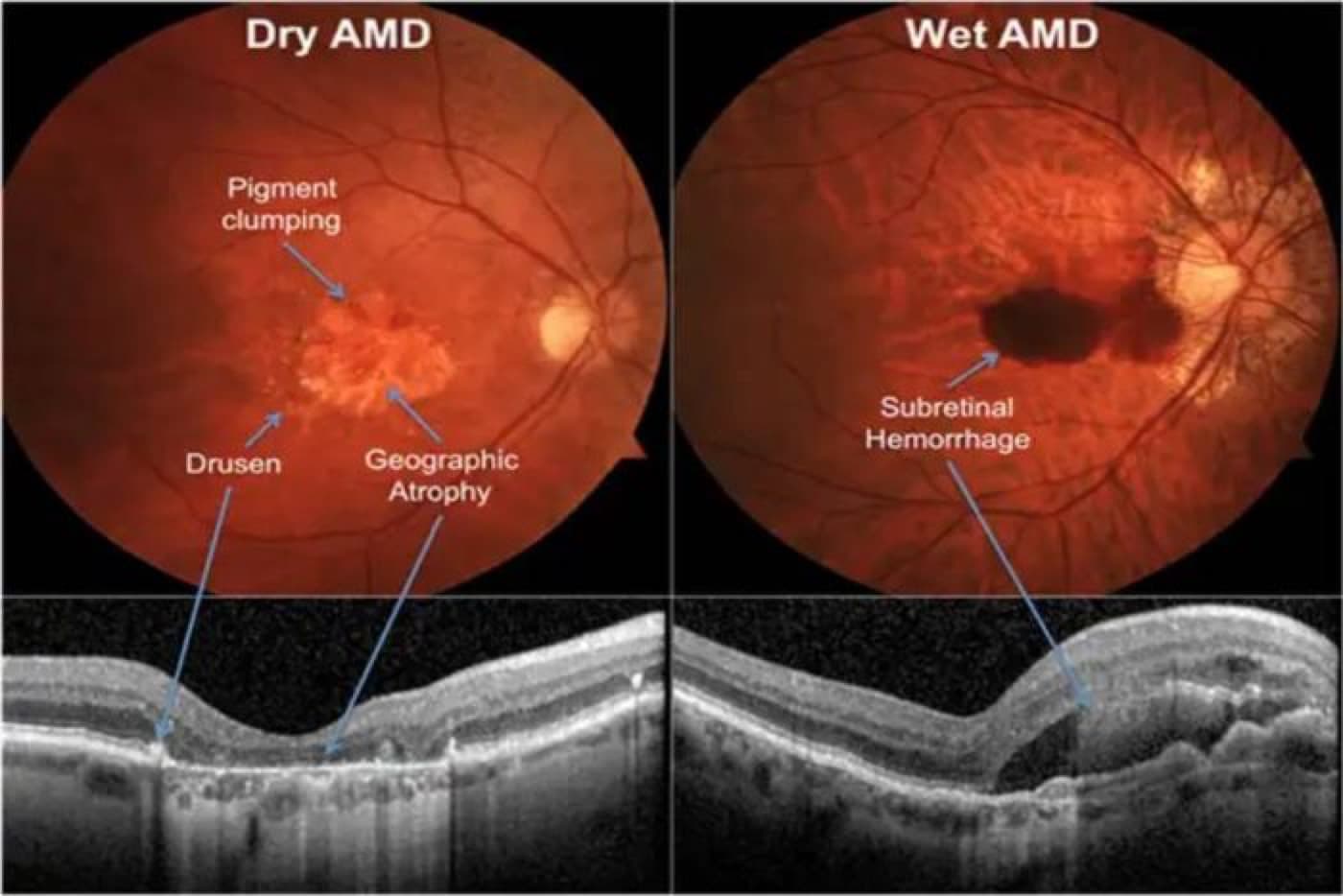 What Is Age-Related Macular Degeneration?